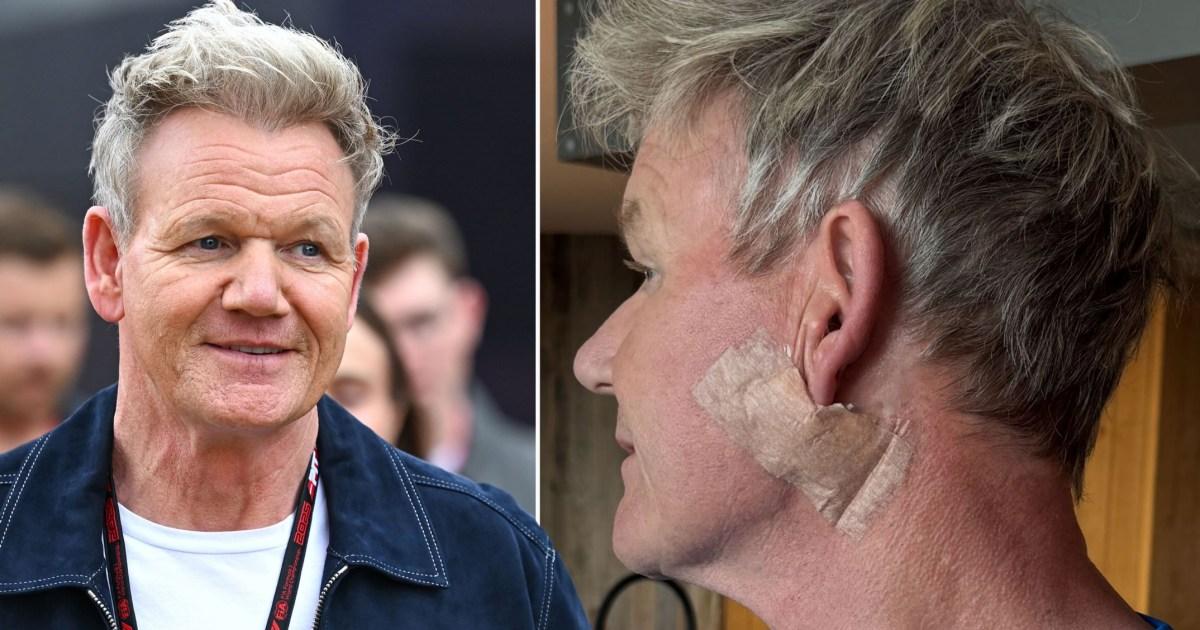 Gordon Ramsay mengungkapkan dia menjalani operasi untuk menghilangkan kanker kulit